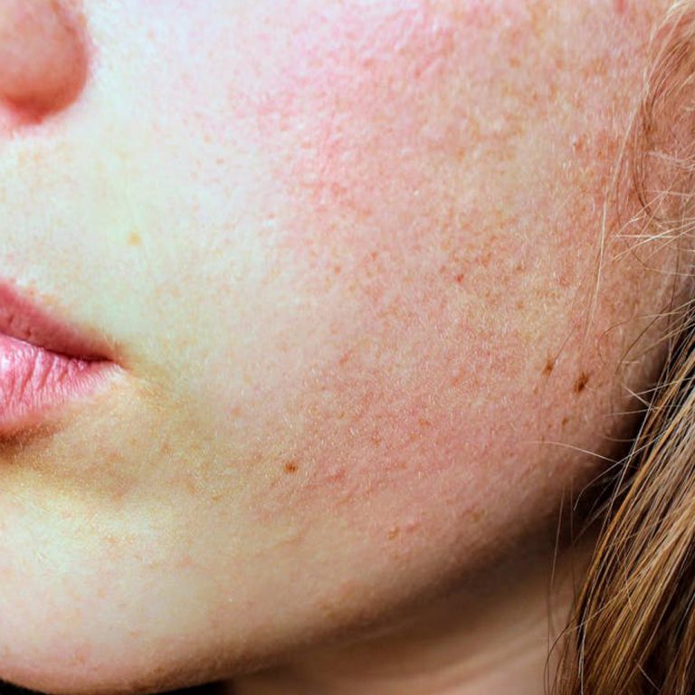 Lee más sobre el artículo ¿Cómo tratar el acné?
