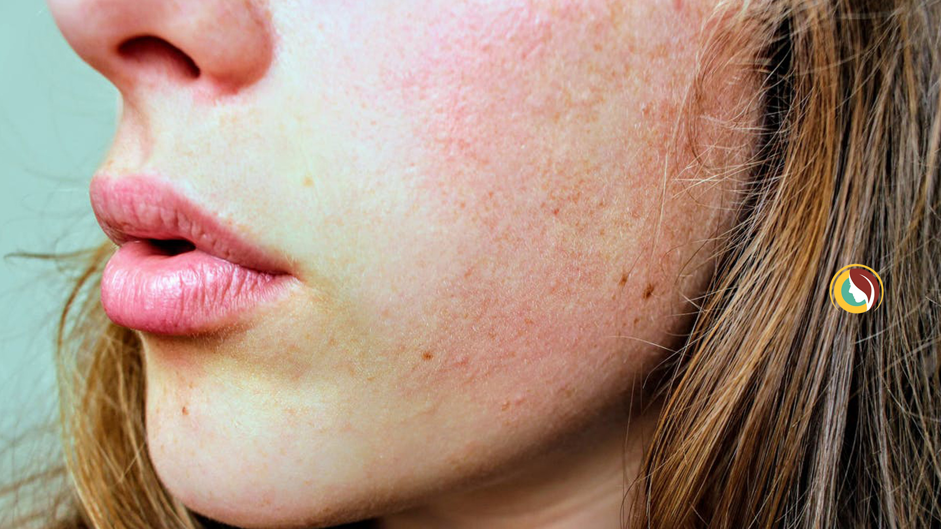 En este momento estás viendo ¿Cómo tratar el acné?